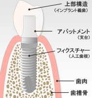 インプラントの構造