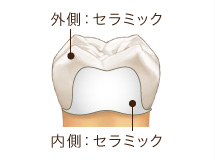 オールセラミッククラウン（e-max）