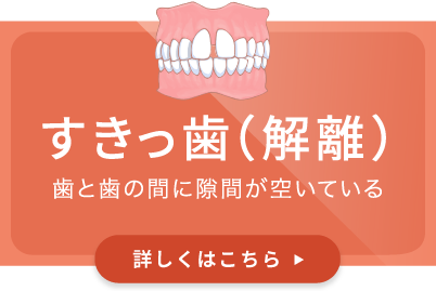 すきっ歯（解離）／歯と歯の間に隙間が空いている