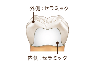 オールセラミック／e-max（詰め物・被せ物）