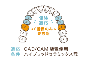 CADCAM冠／保険診療（被せ物）