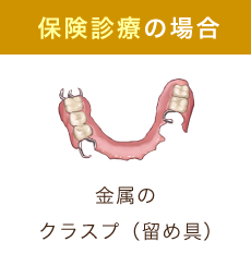 保険診療の場合 金属のクラスプ（留め具）