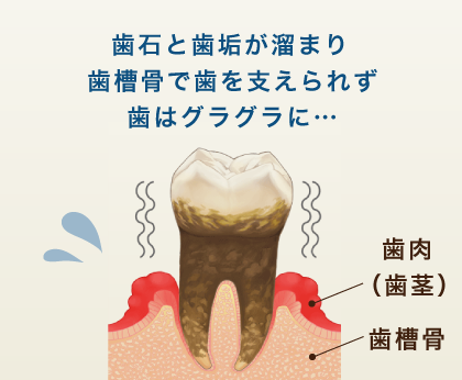 歯石と歯垢が溜まり歯槽骨で歯を支えられず歯はグラグラに…