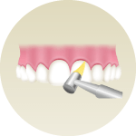 歯間や歯面をクリーニング