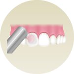 歯の表面をツルツルに仕上げ磨き